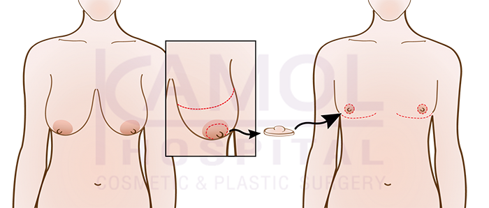 SRS FTM性転換手術 皮下乳房切除術 ラウンド型切開:胸が大きい方または垂れ下がっている方